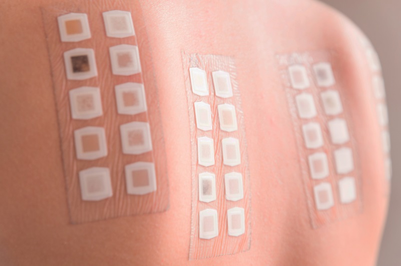 chemical allergy test, metal allergy test, medication allergy, allergen sensitivity assessment